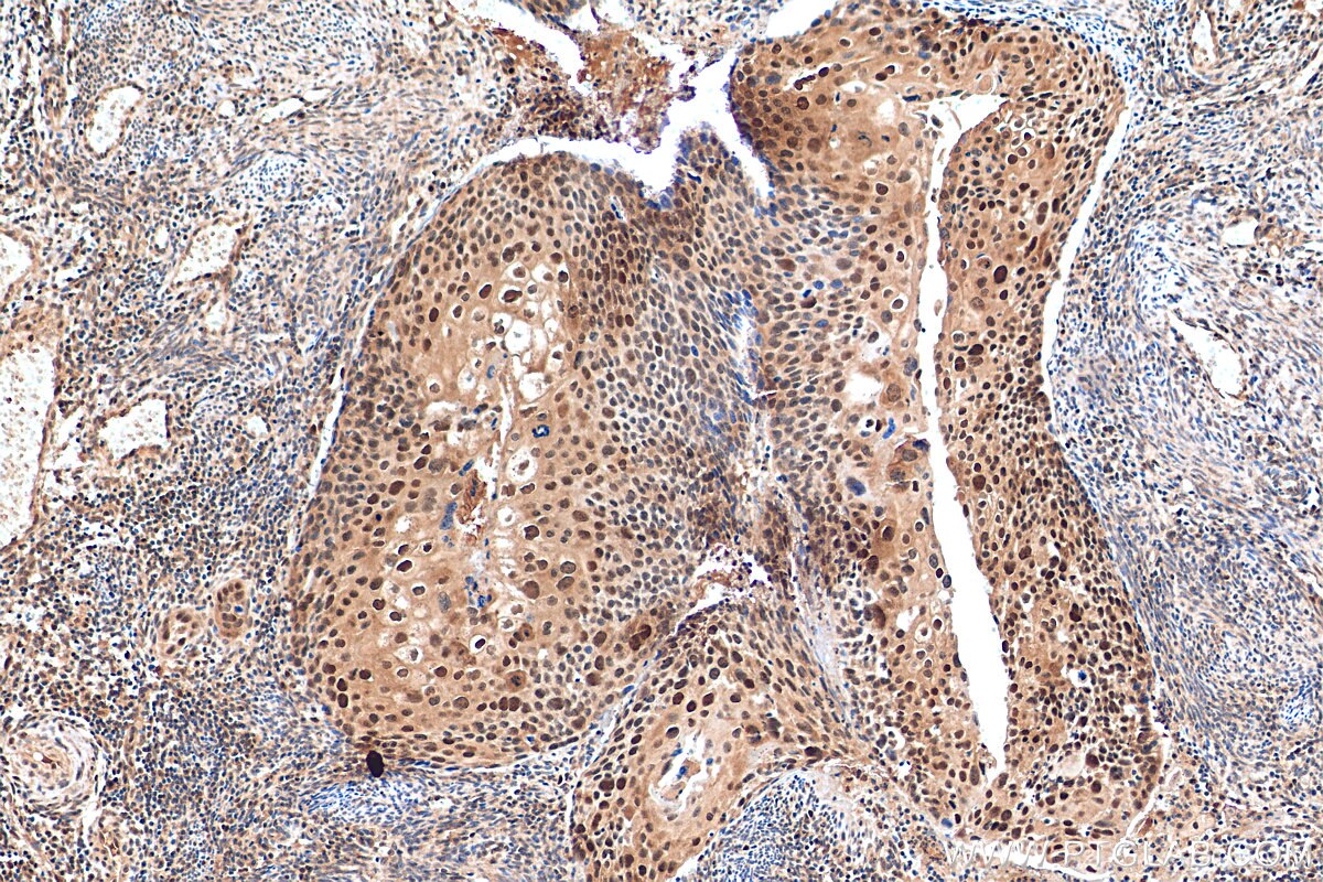 Immunohistochemistry (IHC) staining of human cervical cancer tissue using CDK2 Polyclonal antibody (22060-1-AP)