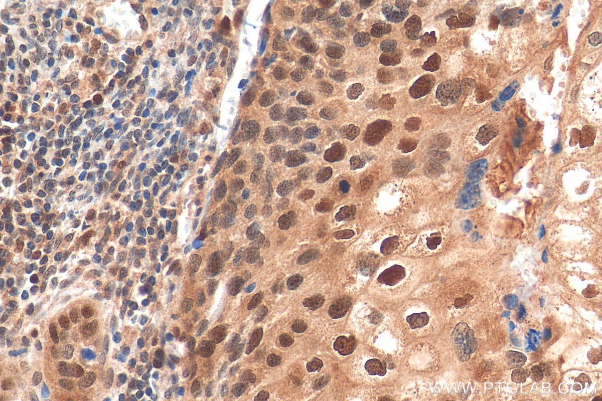 Immunohistochemistry (IHC) staining of human cervical cancer tissue using CDK2 Polyclonal antibody (22060-1-AP)