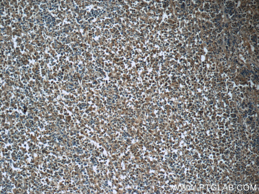 Immunohistochemistry (IHC) staining of human lymphoma tissue using CDK2 Monoclonal antibody (60312-1-Ig)