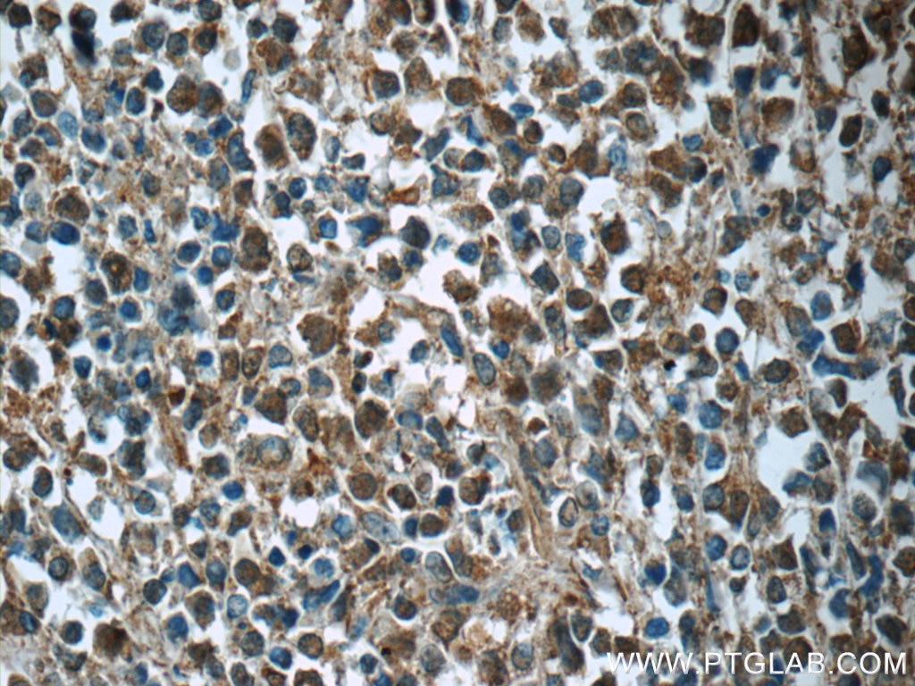Immunohistochemistry (IHC) staining of human lymphoma tissue using CDK2 Monoclonal antibody (60312-1-Ig)