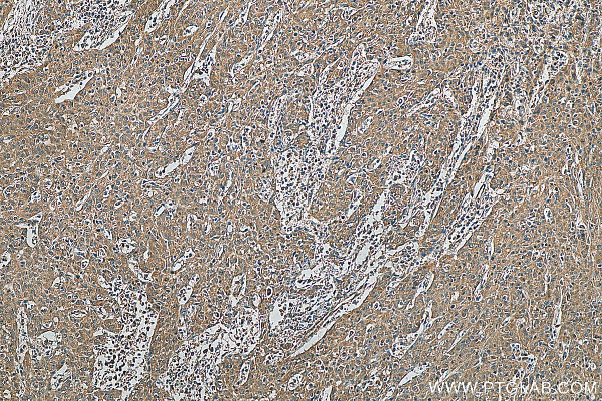 Immunohistochemistry (IHC) staining of human cervical cancer tissue using CDK2 Monoclonal antibody (60312-1-Ig)