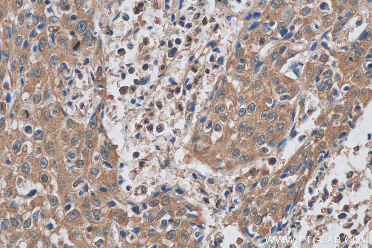 Immunohistochemistry (IHC) staining of human cervical cancer tissue using CDK2 Monoclonal antibody (60312-1-Ig)
