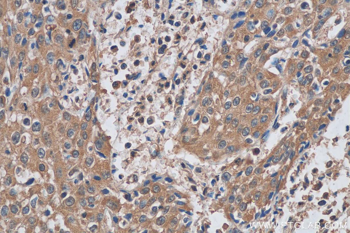 IHC staining of human cervical cancer using 60312-1-Ig