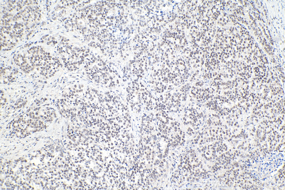 IHC staining of human ovary tumor using 15423-1-AP Immunohistochemistry (IHC) staining of human ovary tumor tissue using CDK2AP2 Polyclonal antibody (15423-1-AP)