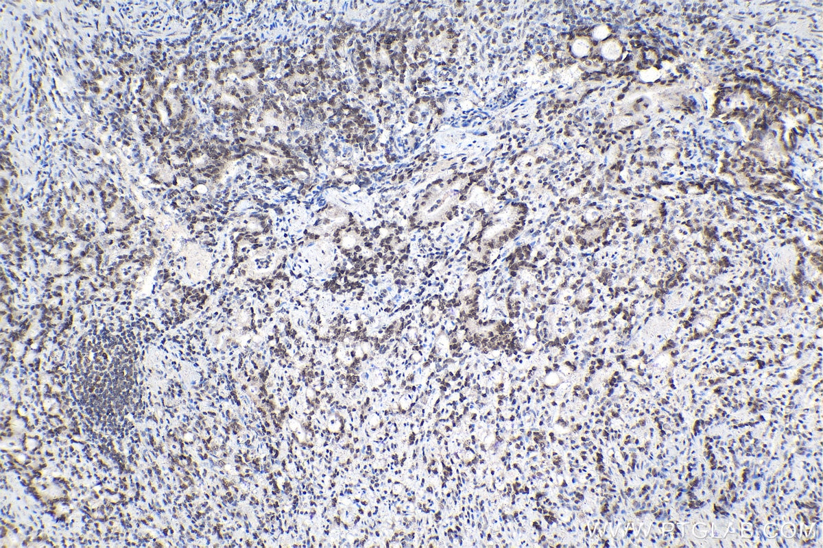 IHC staining of human stomach cancer using 15423-1-AP Immunohistochemistry (IHC) staining of human stomach cancer tissue using CDK2AP2 Polyclonal antibody (15423-1-AP)