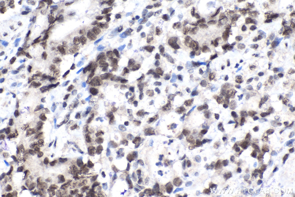 IHC staining of human stomach cancer using 15423-1-AP Immunohistochemistry (IHC) staining of human stomach cancer tissue using CDK2AP2 Polyclonal antibody (15423-1-AP)