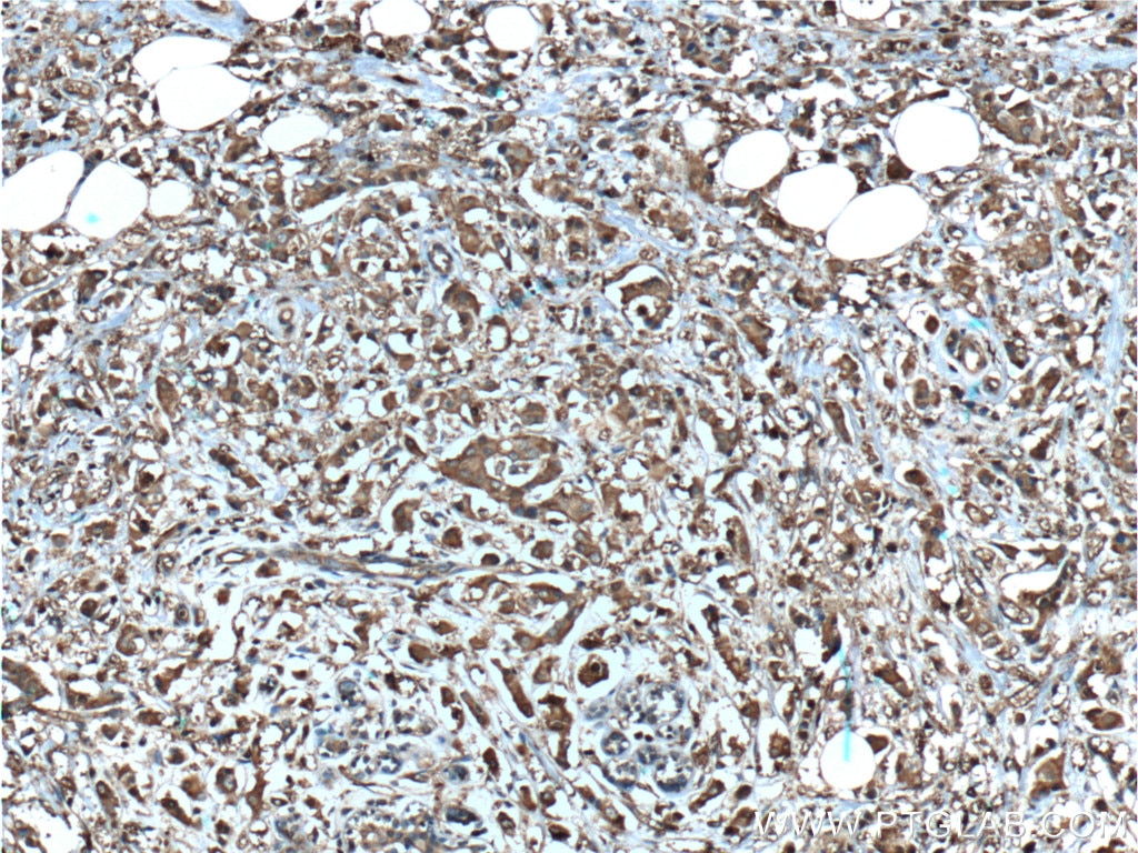 Immunohistochemistry (IHC) staining of human breast cancer tissue using CDK3 Polyclonal antibody (55103-1-AP)