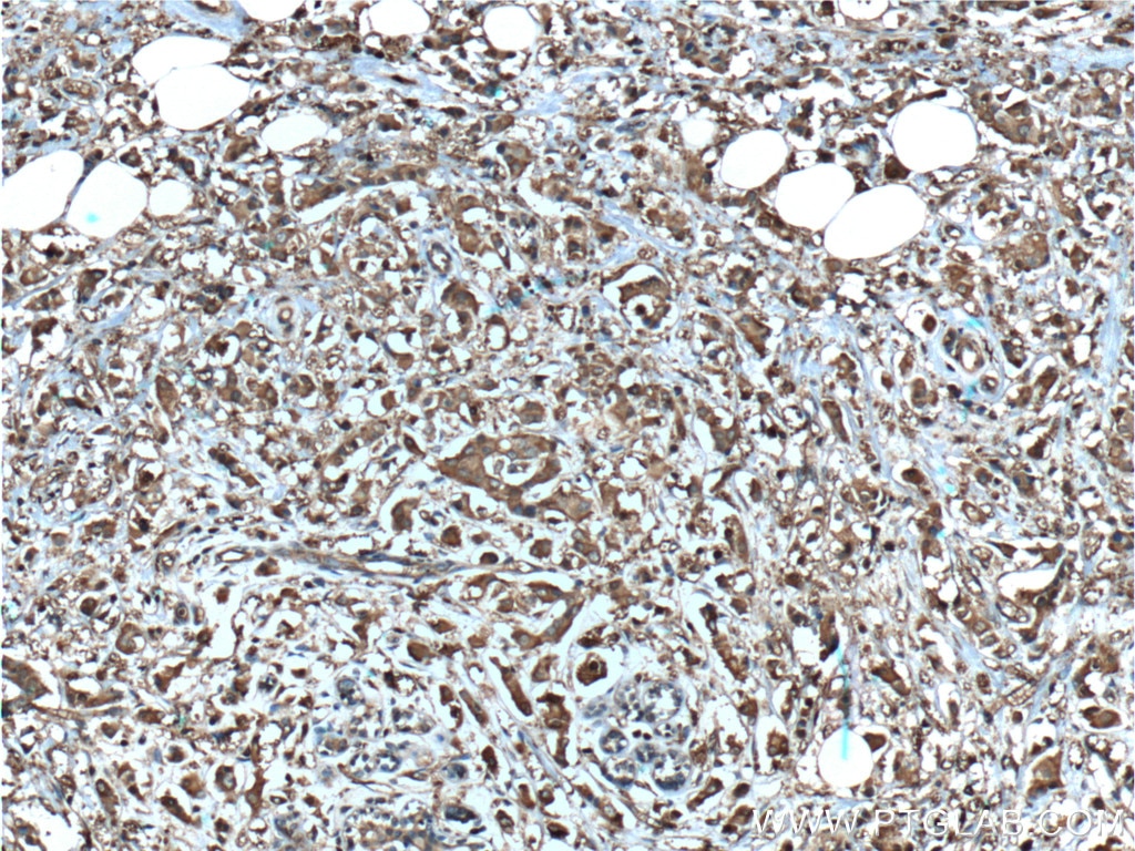 IHC staining of human breast cancer using 55103-1-AP