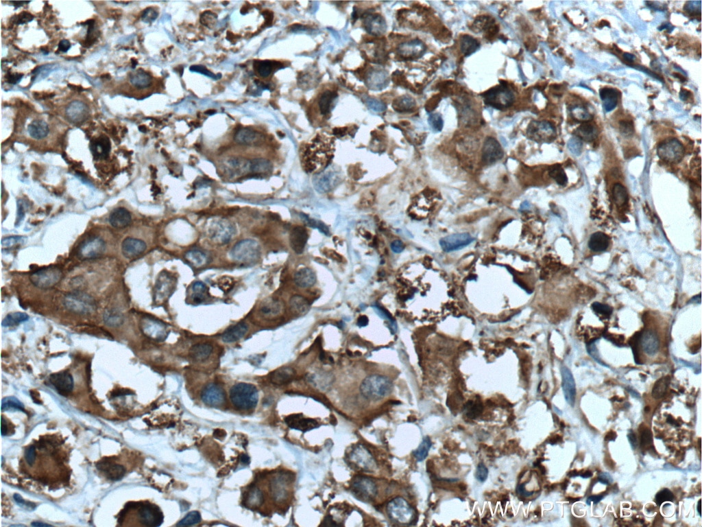 IHC staining of human breast cancer using 55103-1-AP