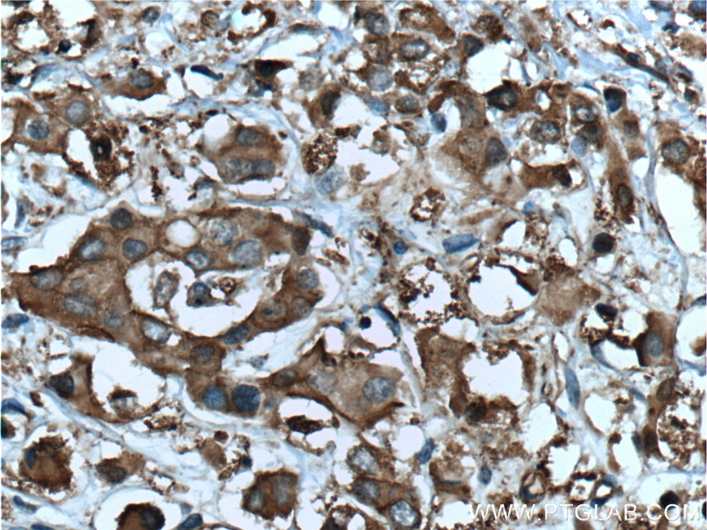 Immunohistochemistry (IHC) staining of human breast cancer tissue using CDK3 Polyclonal antibody (55103-1-AP)