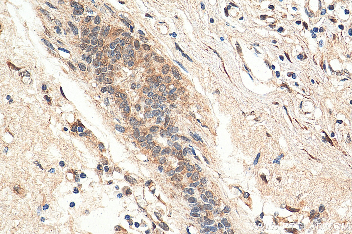 Immunohistochemistry (IHC) staining of human breast cancer tissue using CDK4 Polyclonal antibody (11026-1-AP)