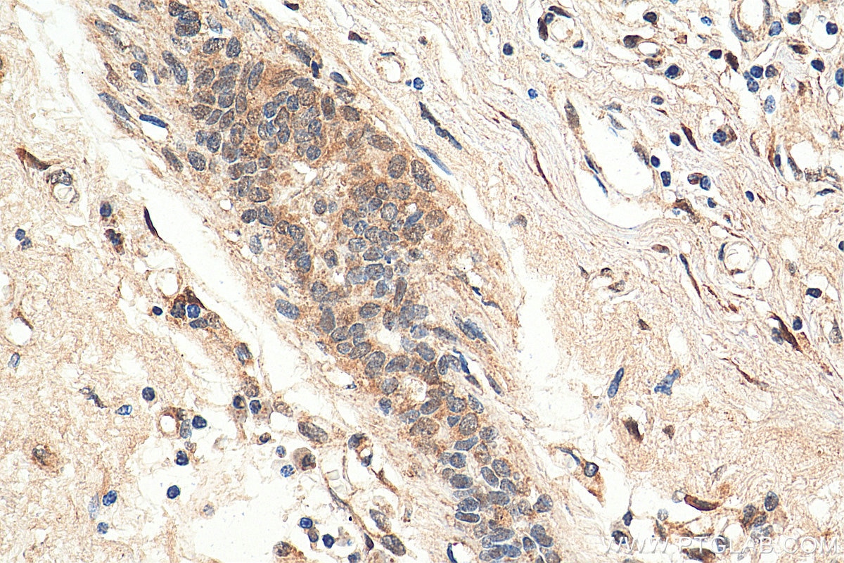 IHC staining of human breast cancer using 11026-1-AP