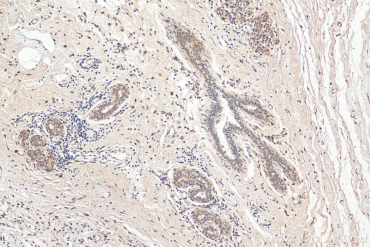 Immunohistochemistry (IHC) staining of human breast cancer tissue using CDK4 Polyclonal antibody (11026-1-AP)