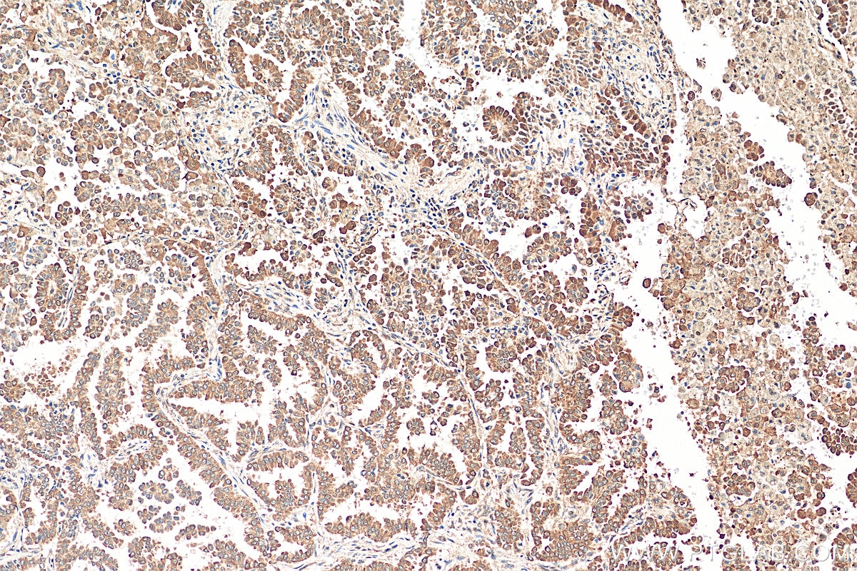 Immunohistochemistry (IHC) staining of human lung cancer tissue using CDK4 Polyclonal antibody (11026-1-AP)