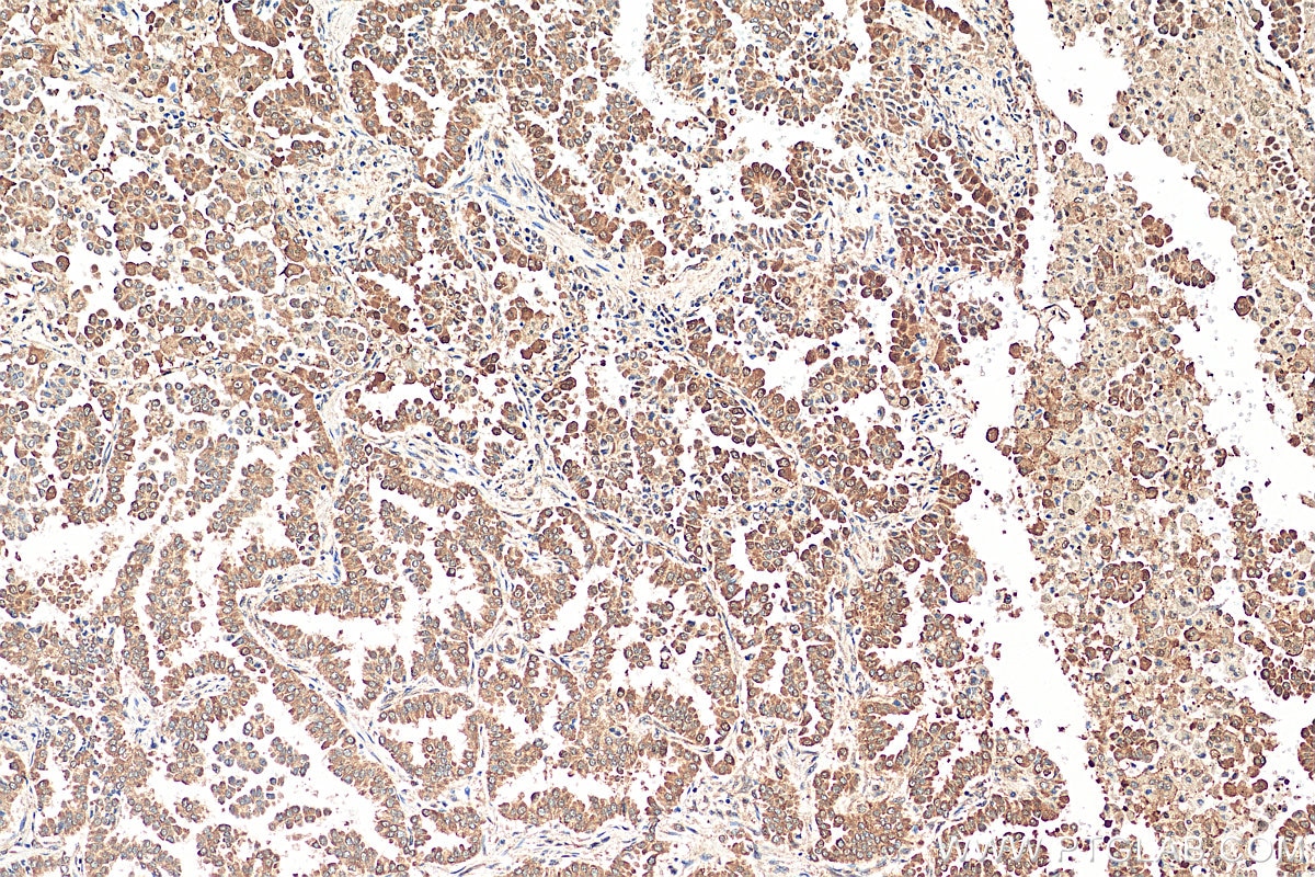 IHC staining of human lung cancer using 11026-1-AP