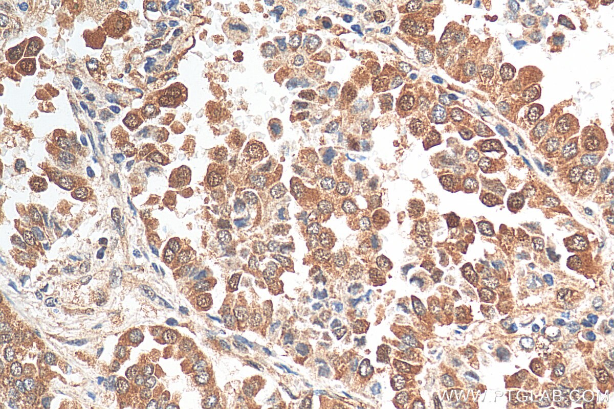 Immunohistochemistry (IHC) staining of human lung cancer tissue using CDK4 Polyclonal antibody (11026-1-AP)