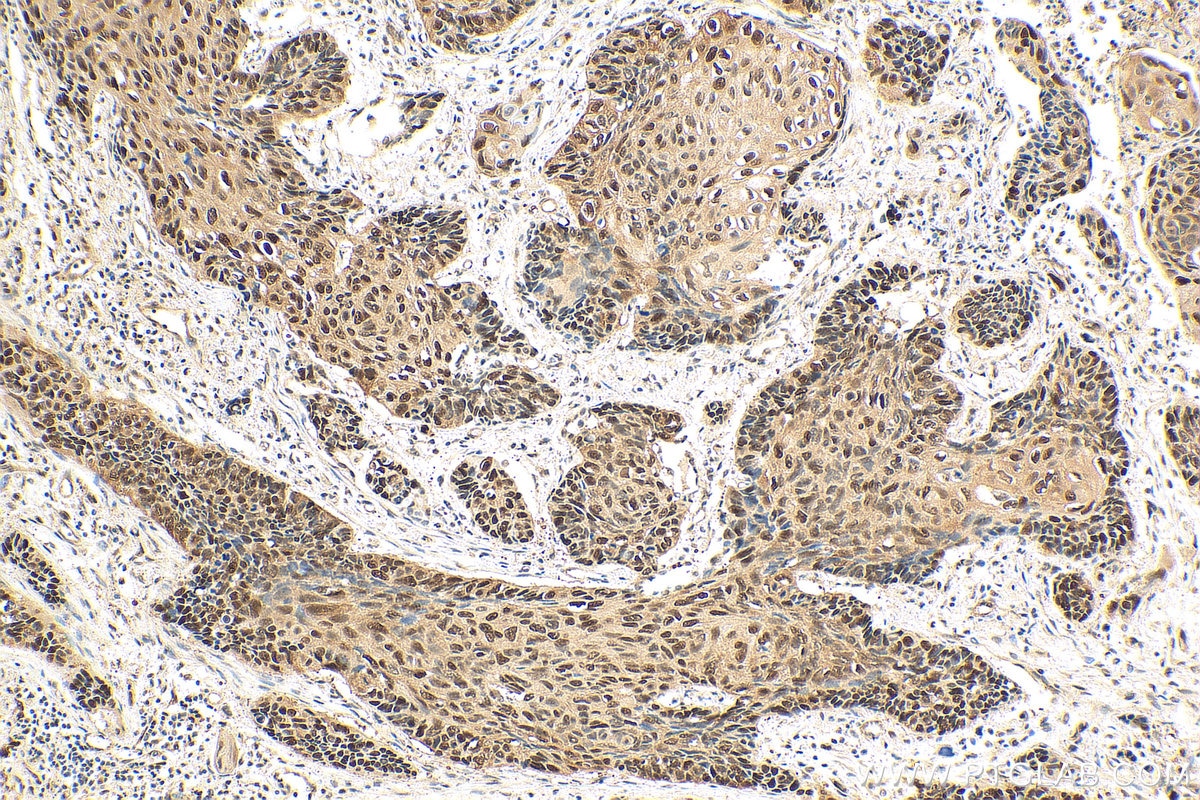 IHC staining of human lung cancer using 11026-1-AP