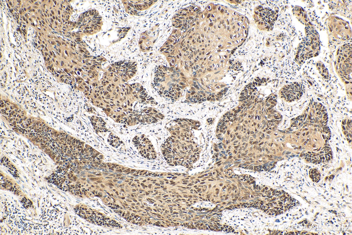 Immunohistochemistry (IHC) staining of human lung cancer tissue using CDK4 Polyclonal antibody (11026-1-AP)