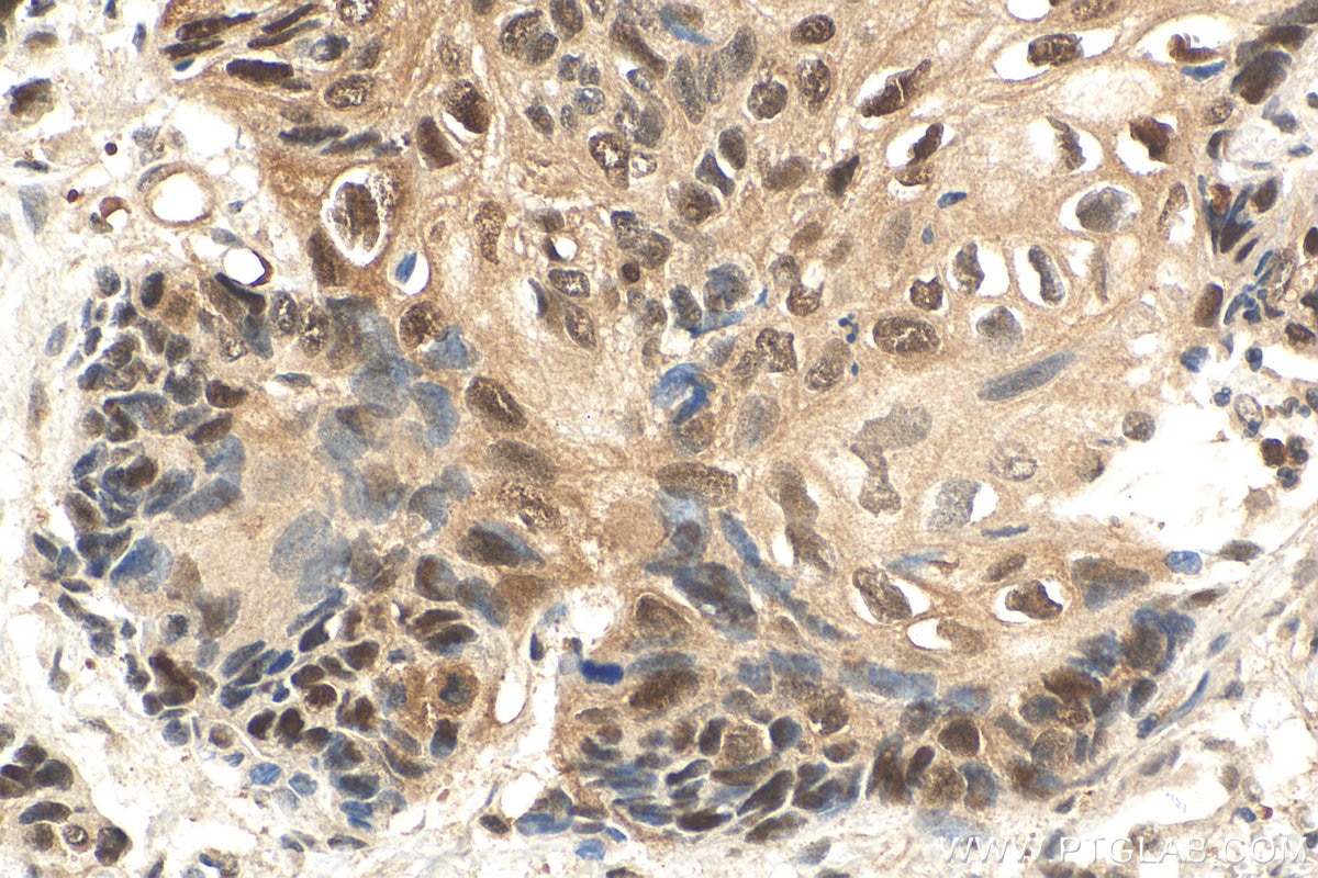 Immunohistochemistry (IHC) staining of human lung cancer tissue using CDK4 Polyclonal antibody (11026-1-AP)