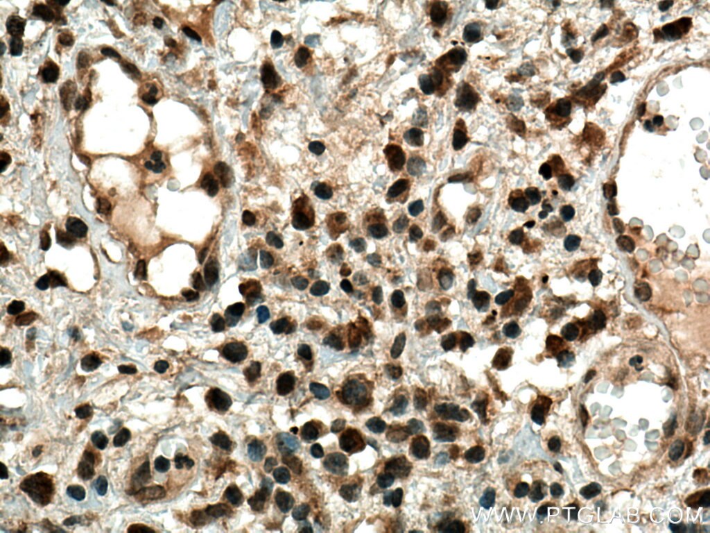 Immunohistochemistry (IHC) staining of human lung cancer tissue using CDK4 Monoclonal antibody (66950-1-Ig)