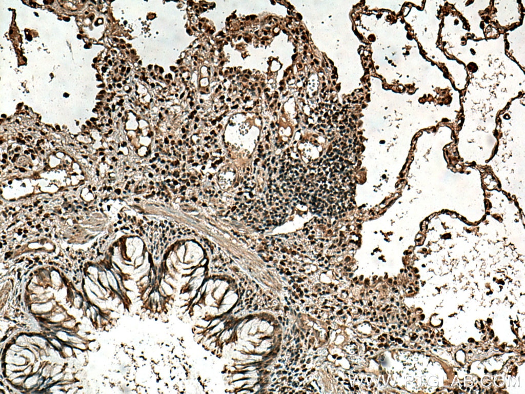 Immunohistochemistry (IHC) staining of human lung cancer tissue using CDK4 Monoclonal antibody (66950-1-Ig)
