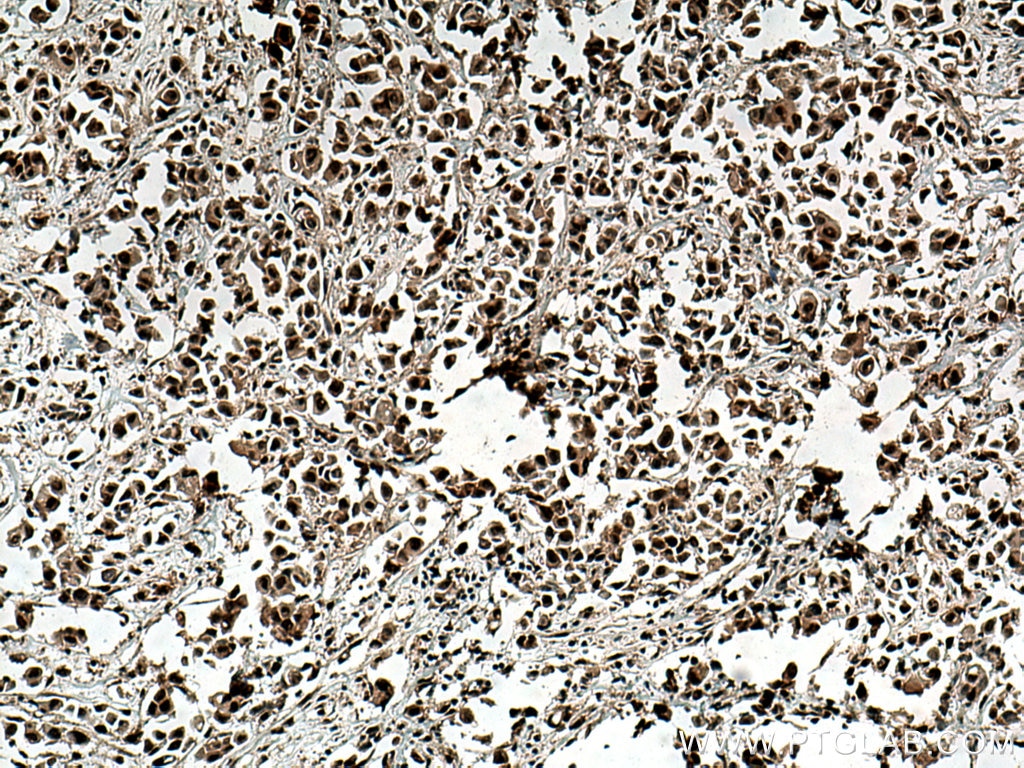 Immunohistochemistry (IHC) staining of human breast cancer tissue using CDK4 Monoclonal antibody (66950-1-Ig)