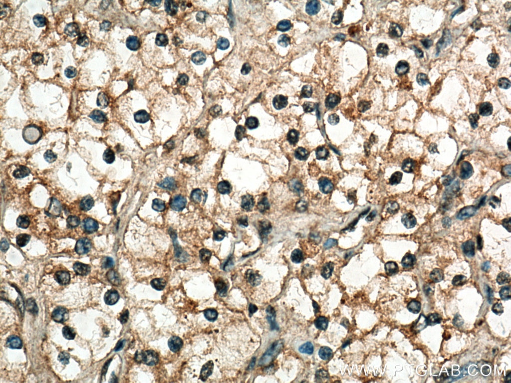 Immunohistochemistry (IHC) staining of human renal cell carcinoma tissue using CDK5 Polyclonal antibody (10430-1-AP)