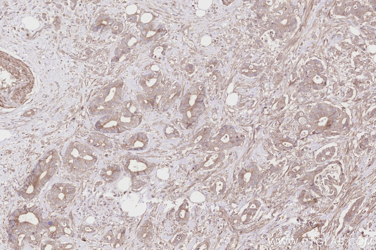 IHC staining of human rectal cancer using 31702-1-AP Immunohistochemistry (IHC) staining of human rectal cancer tissue using CDK5RAP2 Polyclonal antibody (31702-1-AP)