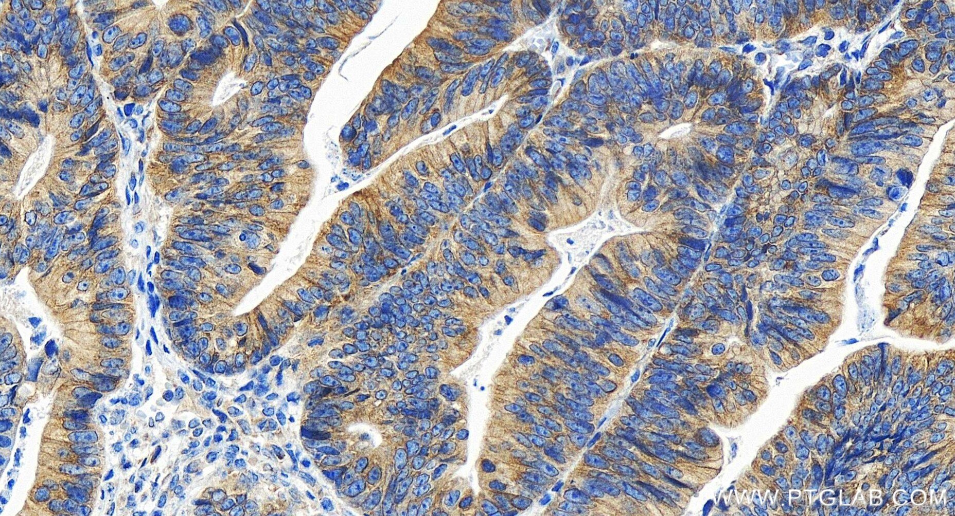 Immunohistochemistry (IHC) staining of human colon cancer tissue using CDK5RAP3 Recombinant antibody (86177-2-RR)