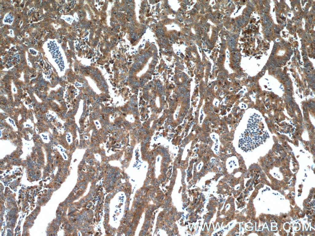 Immunohistochemistry (IHC) staining of human endometrial cancer tissue using CDK6 Polyclonal antibody (14052-1-AP)