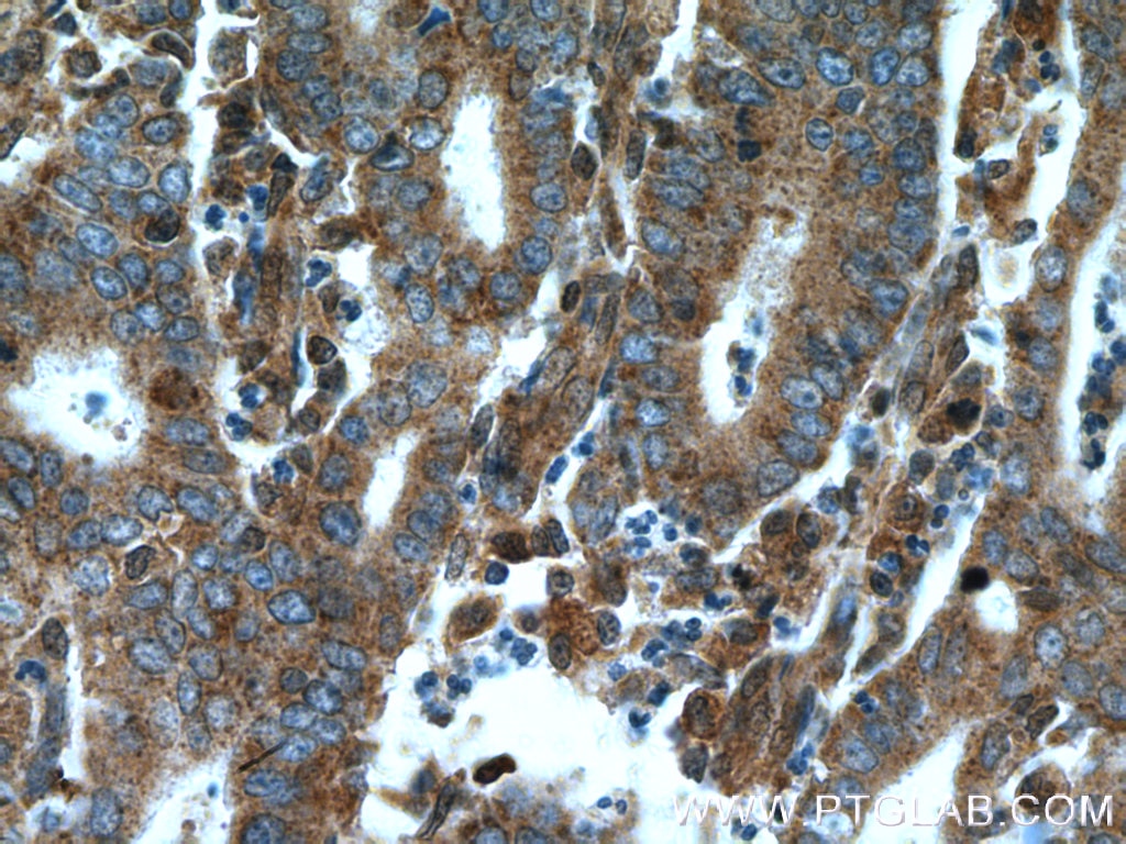Immunohistochemistry (IHC) staining of human endometrial cancer tissue using CDK6 Polyclonal antibody (14052-1-AP)