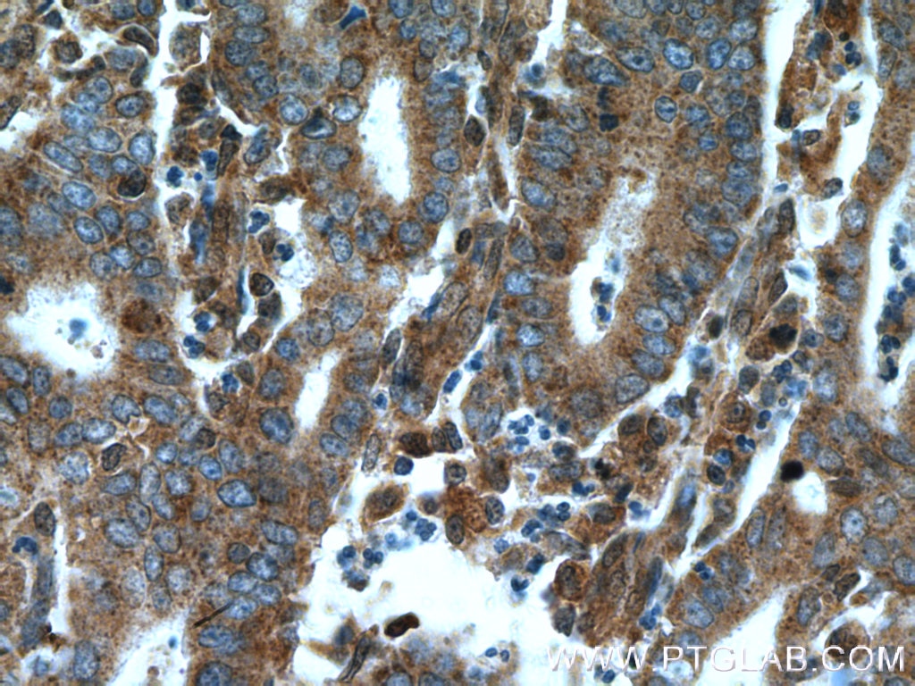 IHC staining of human endometrial cancer using 14052-1-AP