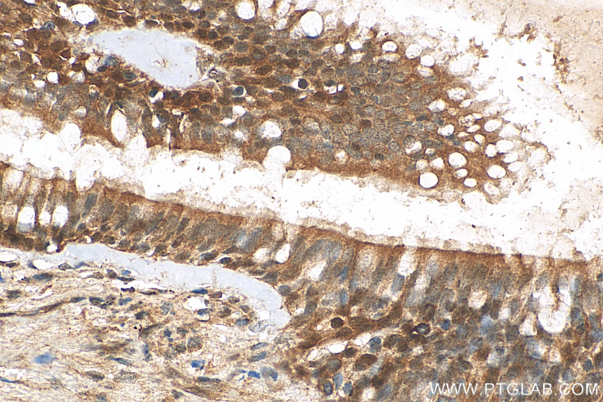 Immunohistochemistry (IHC) staining of human lung cancer tissue using CDK6 Polyclonal antibody (14052-1-AP)