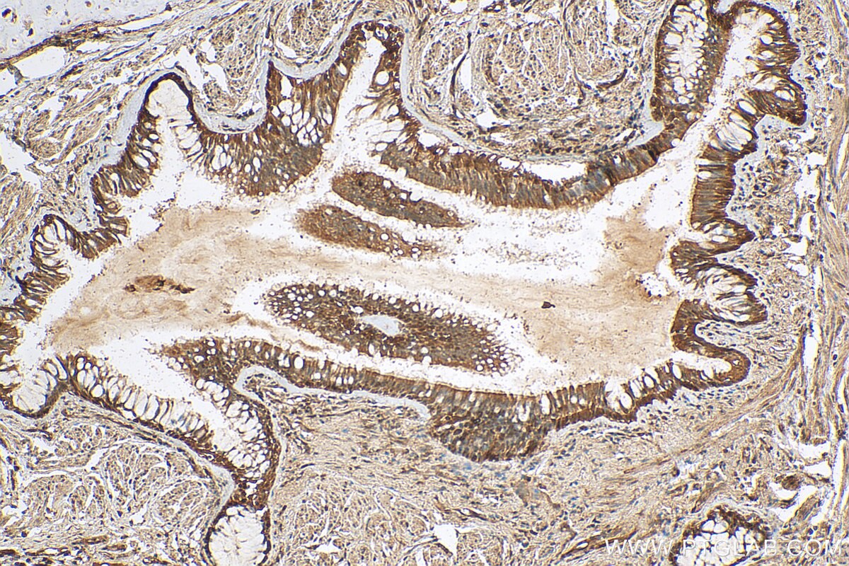 IHC staining of human lung cancer using 14052-1-AP