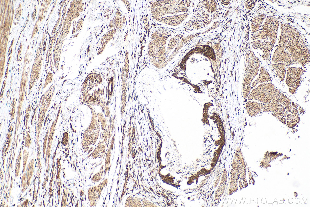 Immunohistochemistry (IHC) staining of human urothelial carcinoma tissue using CDK6 Polyclonal antibody (14052-1-AP)