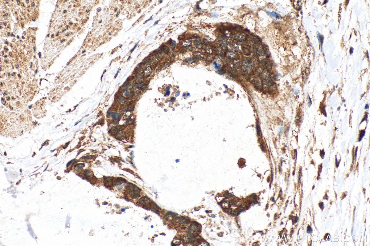 Immunohistochemistry (IHC) staining of human urothelial carcinoma tissue using CDK6 Polyclonal antibody (14052-1-AP)