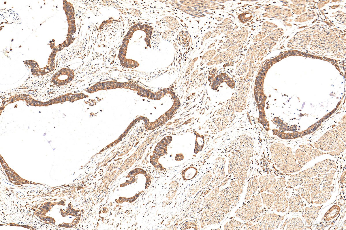 Immunohistochemistry (IHC) staining of human urothelial carcinoma tissue using CDK6 Polyclonal antibody (14052-1-AP)