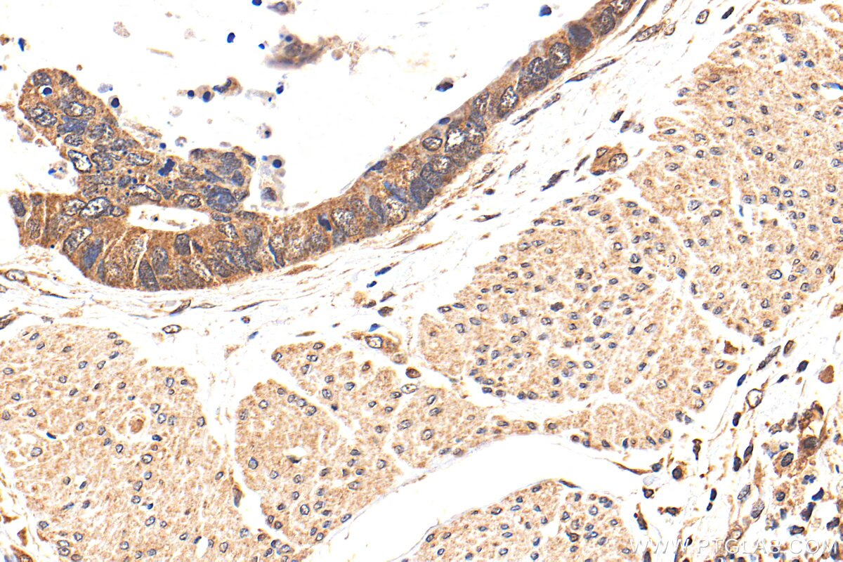 Immunohistochemistry (IHC) staining of human urothelial carcinoma tissue using CDK6 Polyclonal antibody (14052-1-AP)