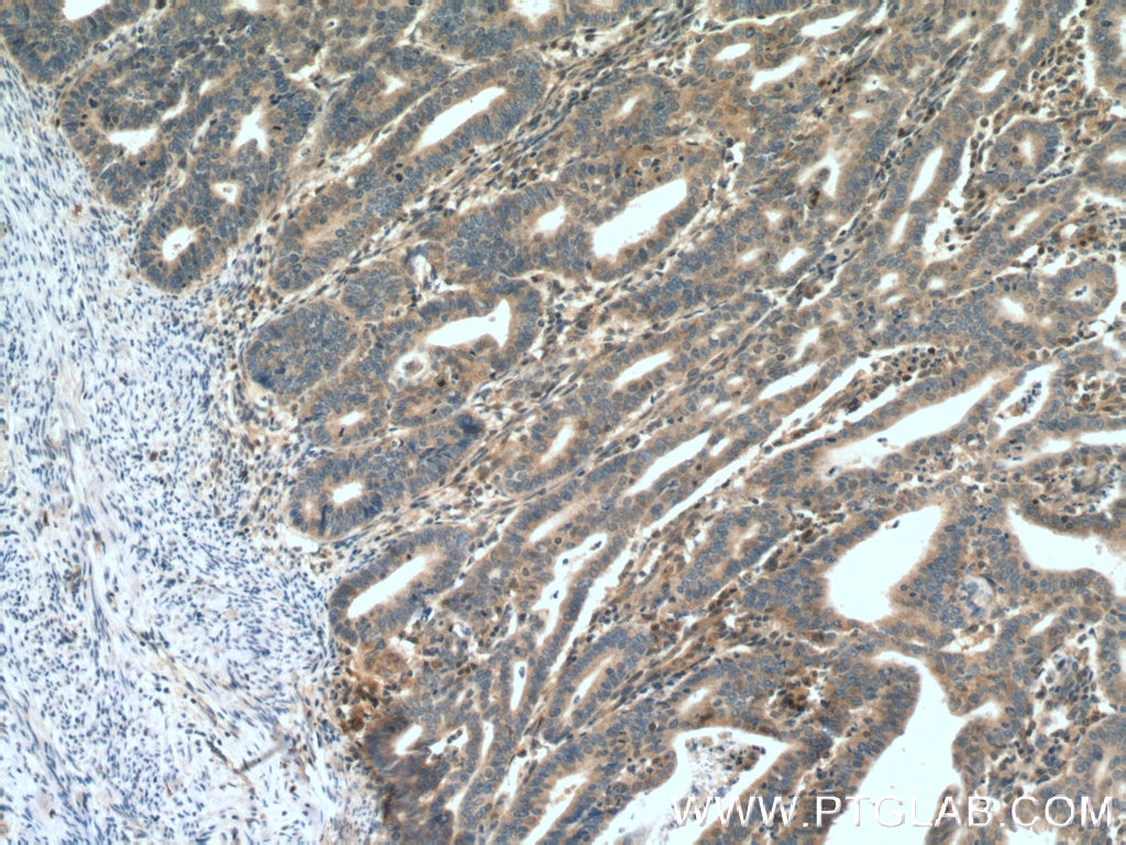 IHC staining of human endometrial cancer using 19117-1-AP