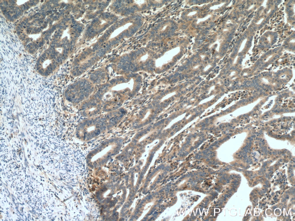 Immunohistochemistry (IHC) staining of human endometrial cancer tissue using CDK6 Polyclonal antibody (19117-1-AP)