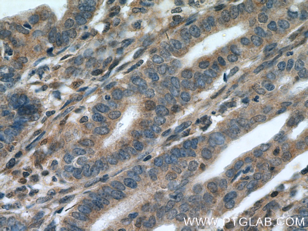 Immunohistochemistry (IHC) staining of human endometrial cancer tissue using CDK6 Polyclonal antibody (19117-1-AP)