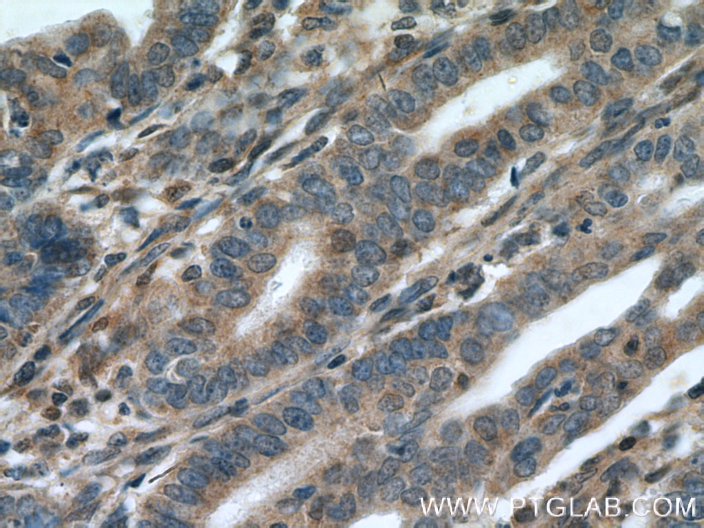 IHC staining of human endometrial cancer using 19117-1-AP