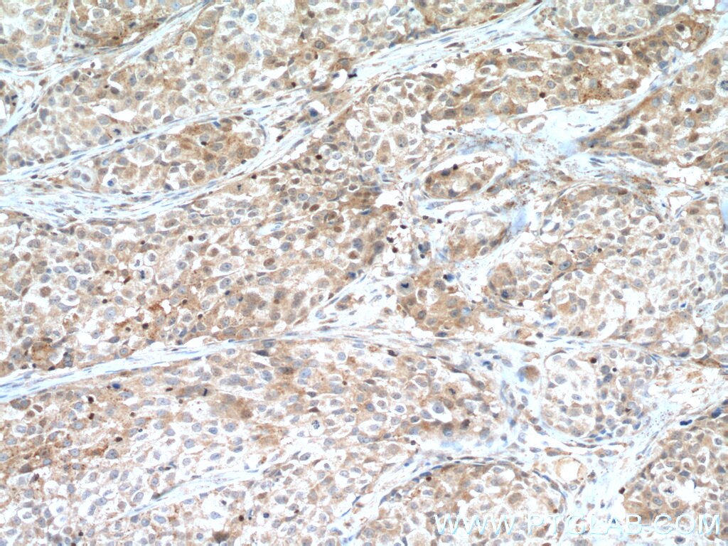 Immunohistochemistry (IHC) staining of human lung cancer tissue using CDK6 Polyclonal antibody (19117-1-AP)