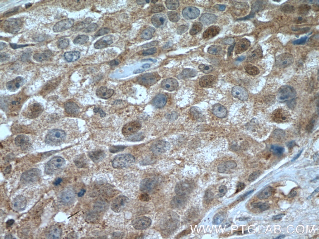 Immunohistochemistry (IHC) staining of human lung cancer tissue using CDK6 Polyclonal antibody (19117-1-AP)