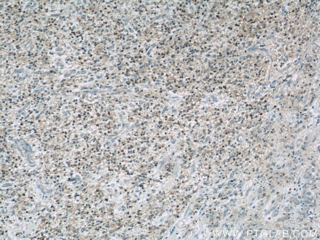 Immunohistochemistry (IHC) staining of human gliomas tissue using CDK6 Polyclonal antibody (19117-1-AP)