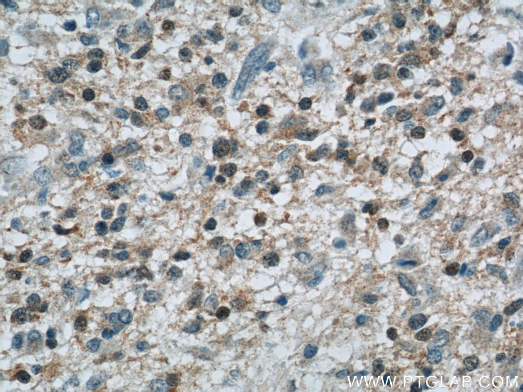 Immunohistochemistry (IHC) staining of human gliomas tissue using CDK6 Polyclonal antibody (19117-1-AP)