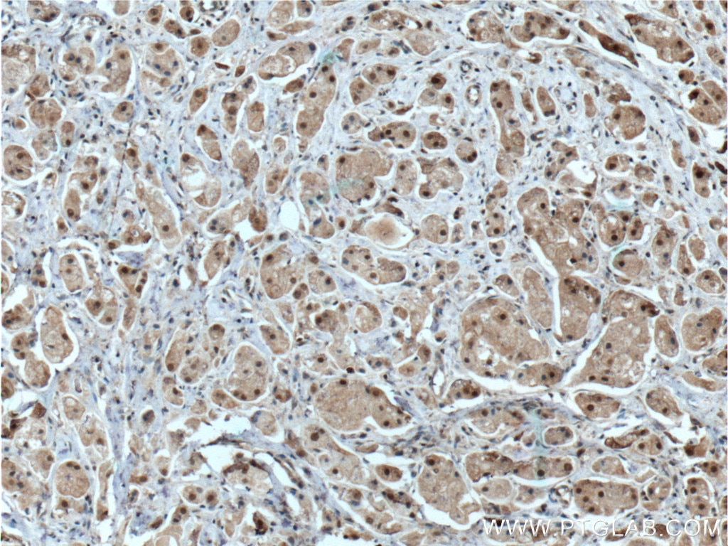 Immunohistochemistry (IHC) staining of human breast cancer tissue using CDK7 Polyclonal antibody (27027-1-AP)