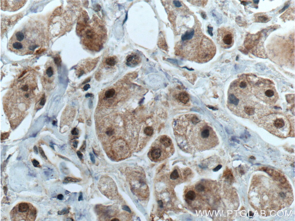 Immunohistochemistry (IHC) staining of human breast cancer tissue using CDK7 Polyclonal antibody (27027-1-AP)