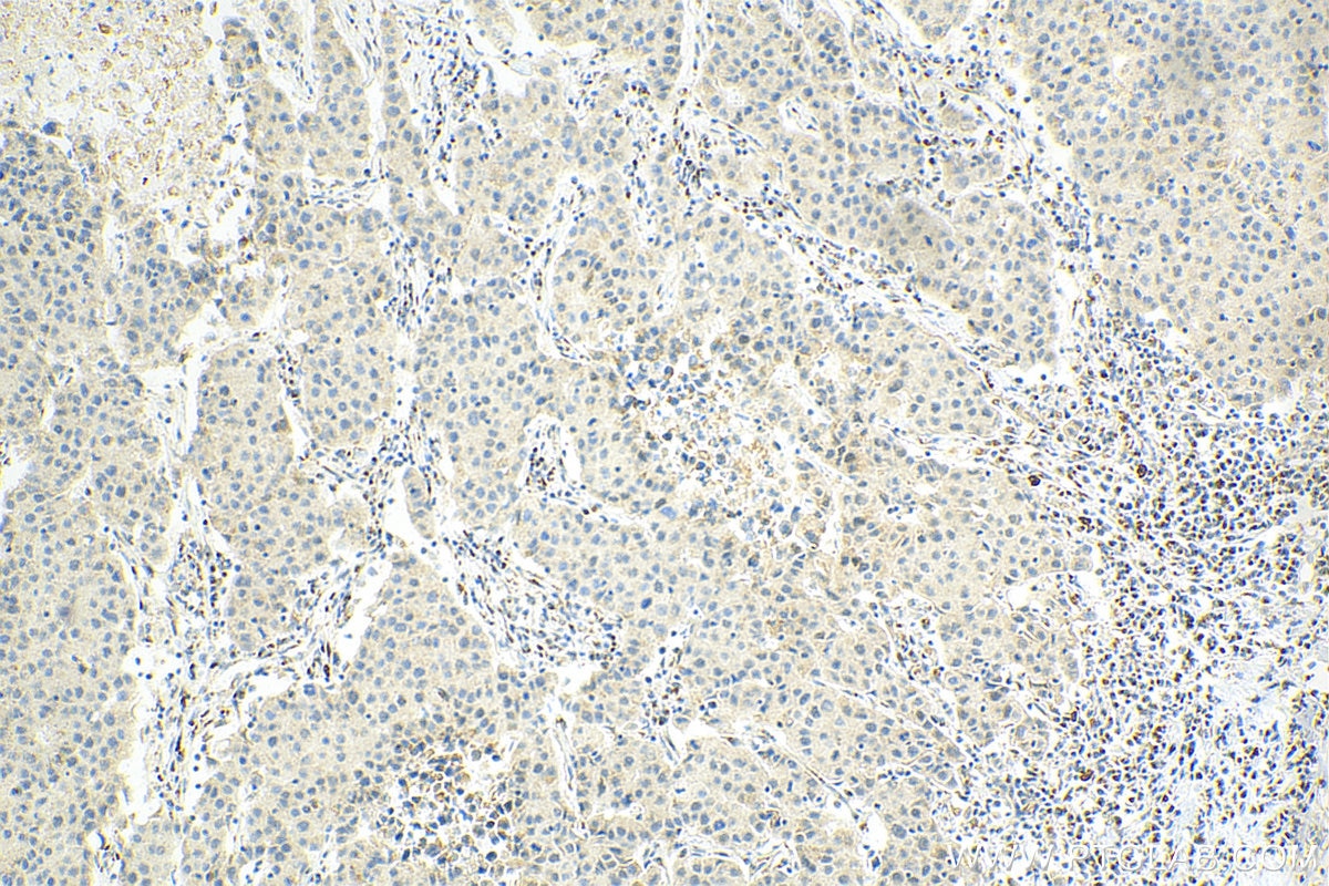 Immunohistochemistry (IHC) staining of human breast cancer tissue using CDK7 Monoclonal antibody (67889-1-Ig)