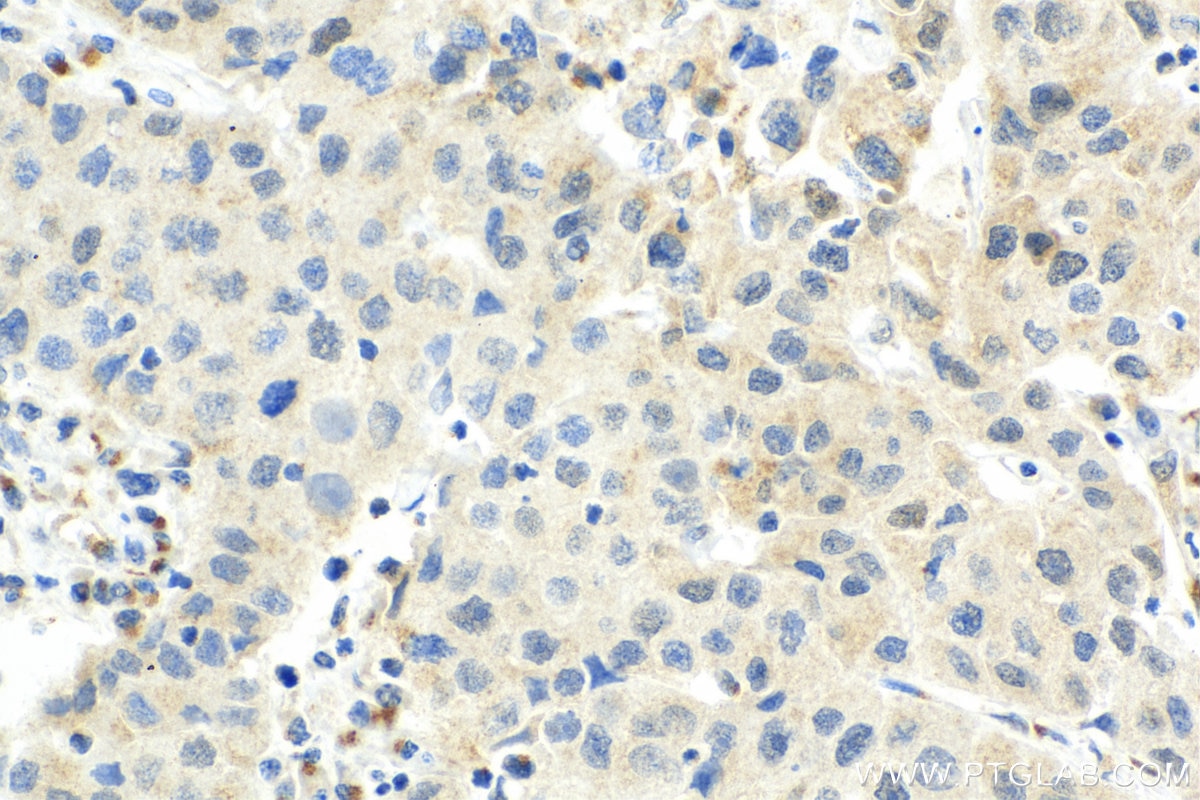 Immunohistochemistry (IHC) staining of human breast cancer tissue using CDK7 Monoclonal antibody (67889-1-Ig)